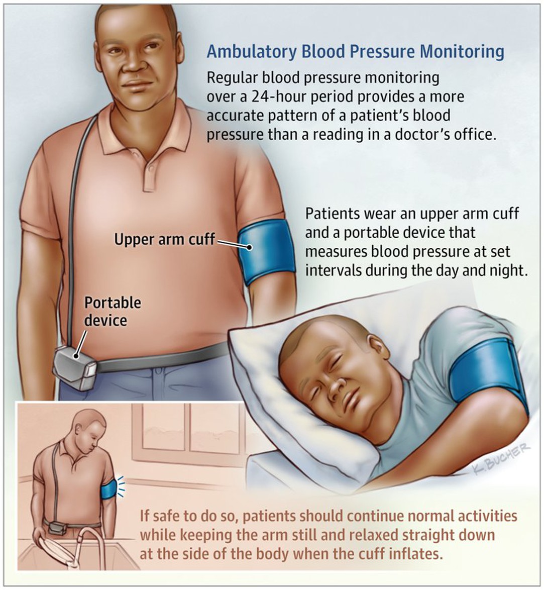 Is there a 24 7 blood pressure monitor Is there a 24 7 blood pressure monitor